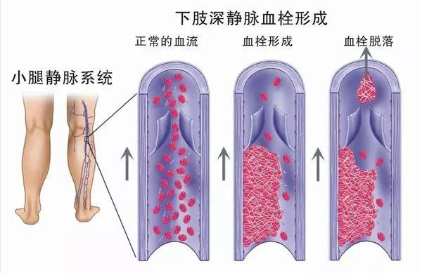 25岁小伙玩电脑游戏6小时，发生“电脑血栓病”，差点没命